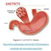 undefined Gastrite-Química