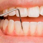 Podcast Podcast de Periodontite