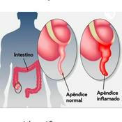 Podcast Principais Sintomas Do Apendicite